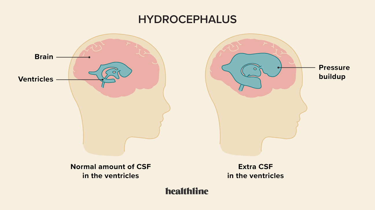 Hydrocephalus Symptoms Causes And Treatment 6013