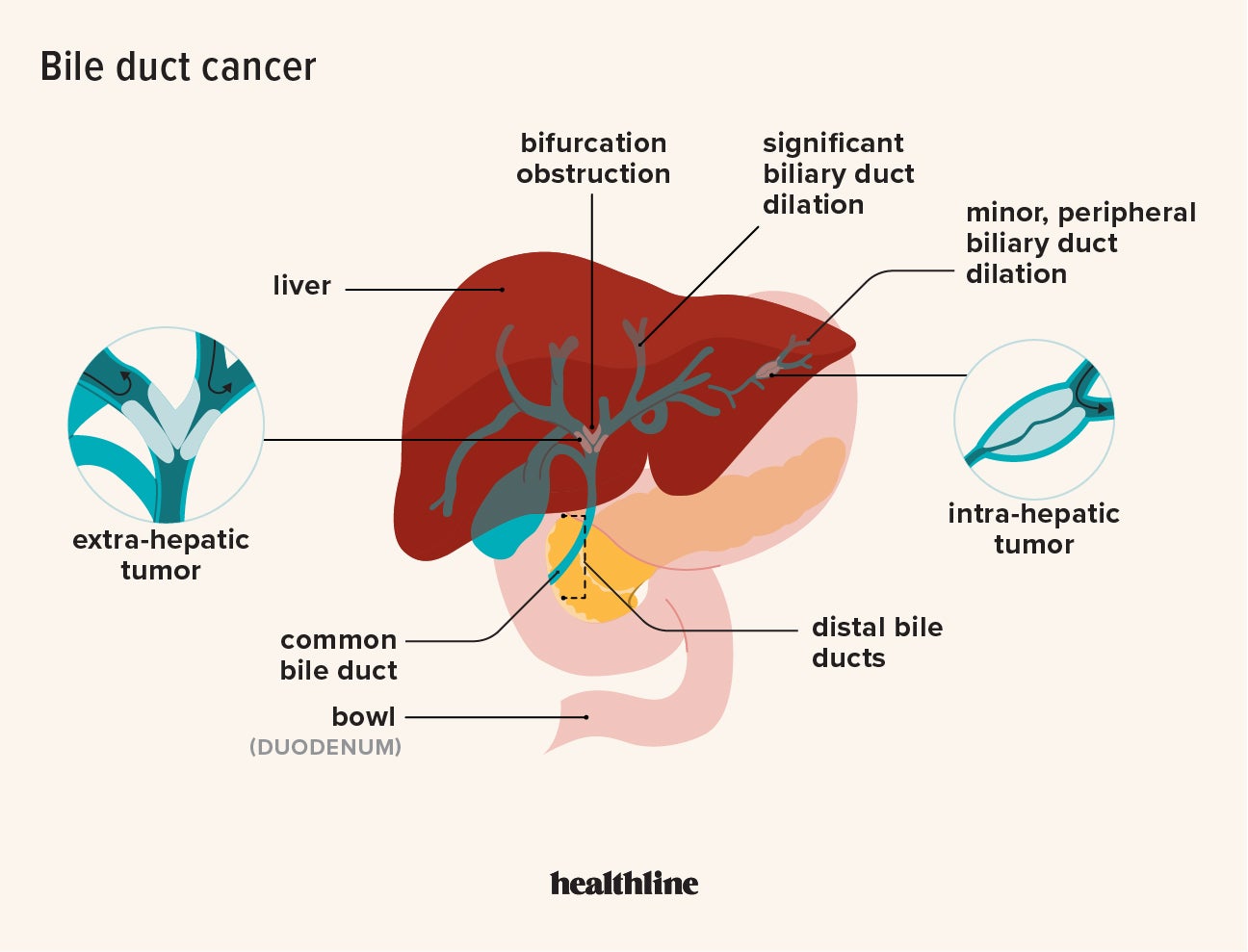 Bile Duct Cancer Stages What To Know