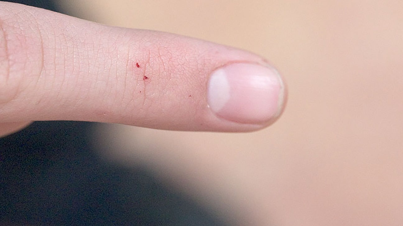 Bedbugs Bites What They Look Like Treatment And More