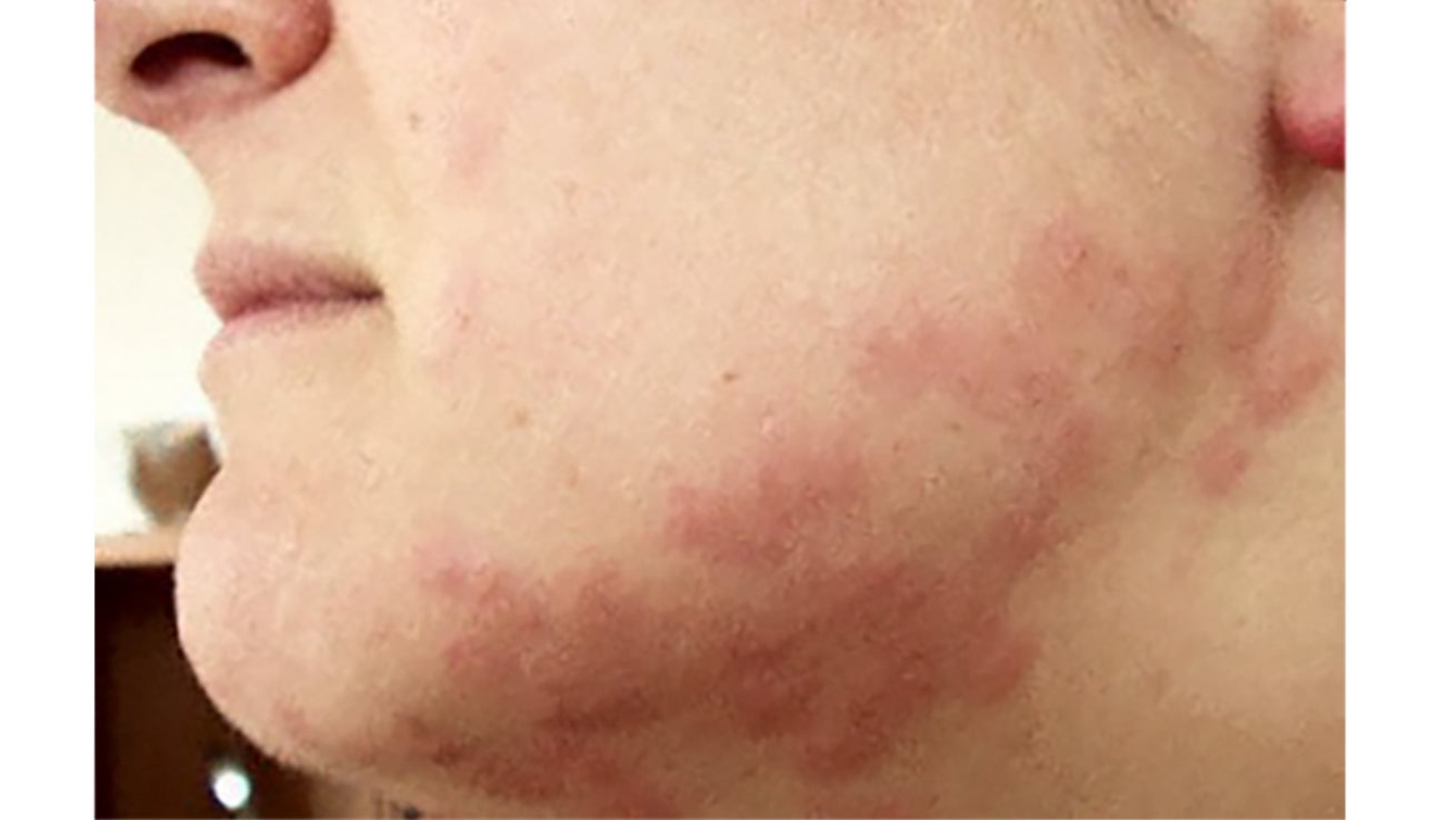 bed bug bites on face and neck