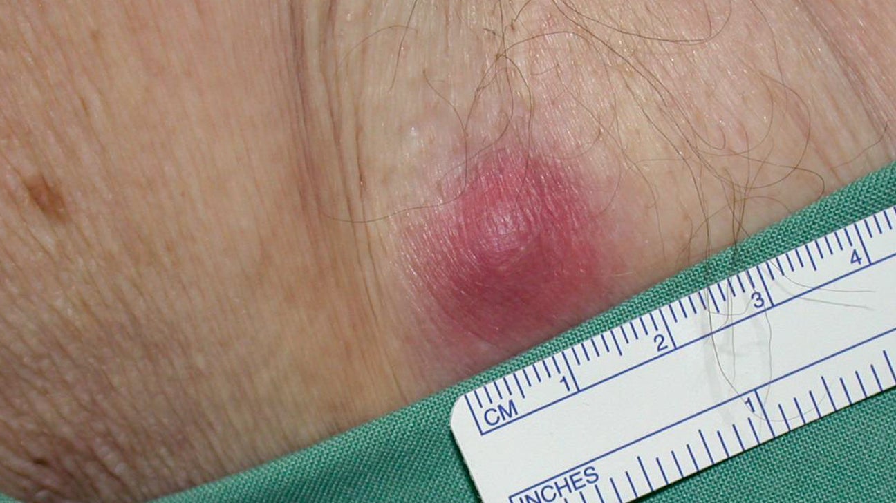 Type 2 Diabetes and Skin: Pictures, Dermopathy, Infections, and More