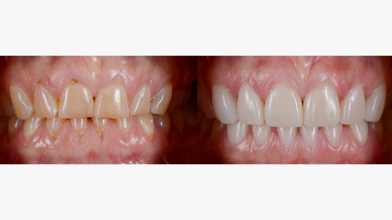 Dental Veneers Before And After Slide1 