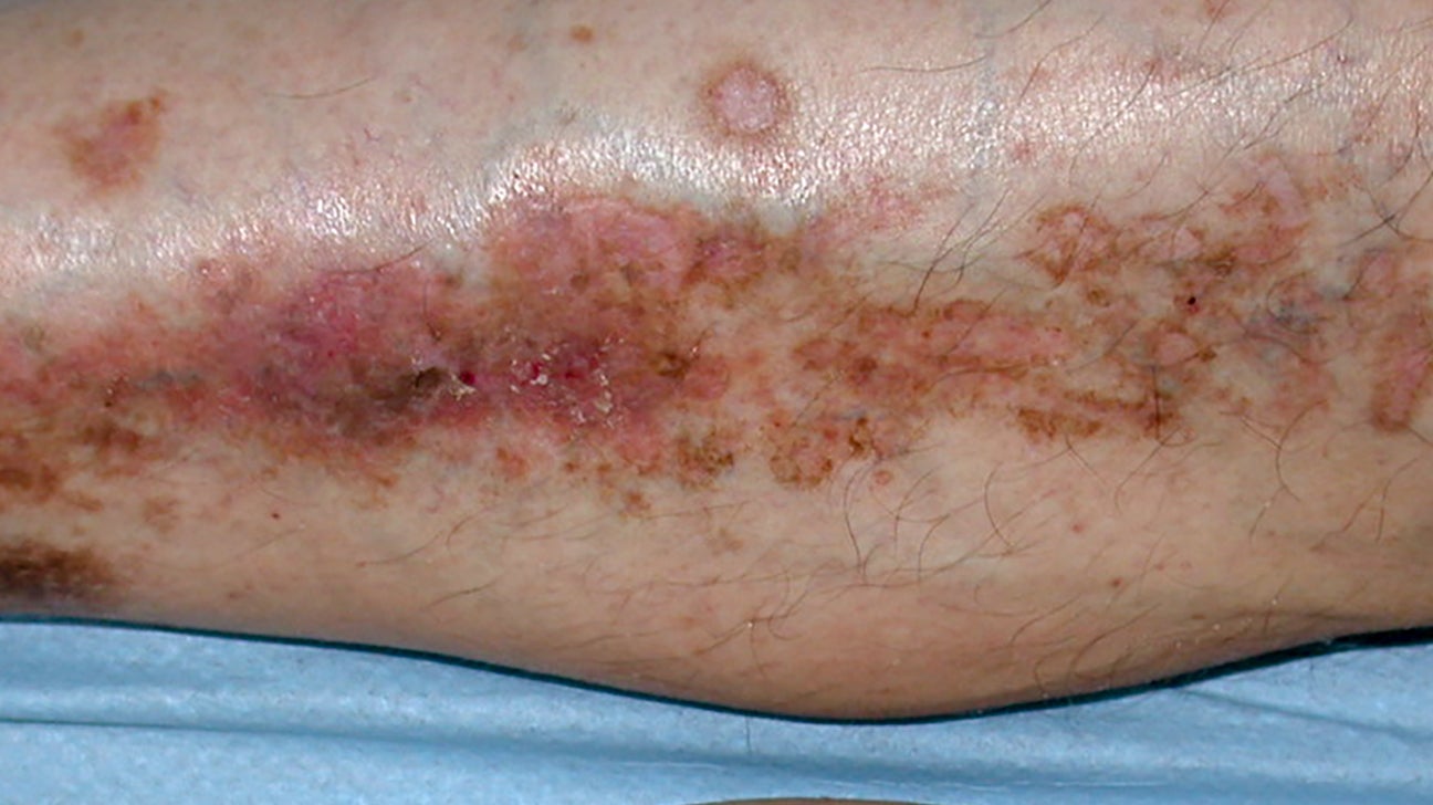 Type 2 Diabetes and Skin: Pictures, Dermopathy, Infections, and More