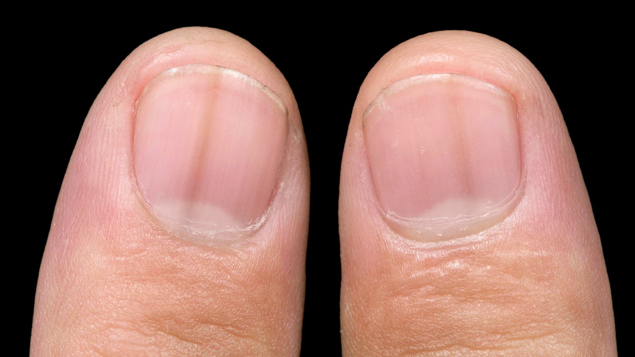 What Causes Toenail Discoloration at Hillary Bates blog