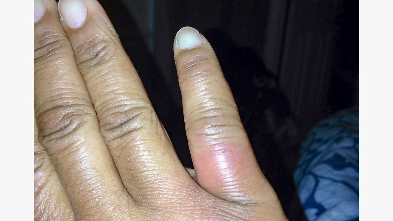 what does a brown recluse bite first look like