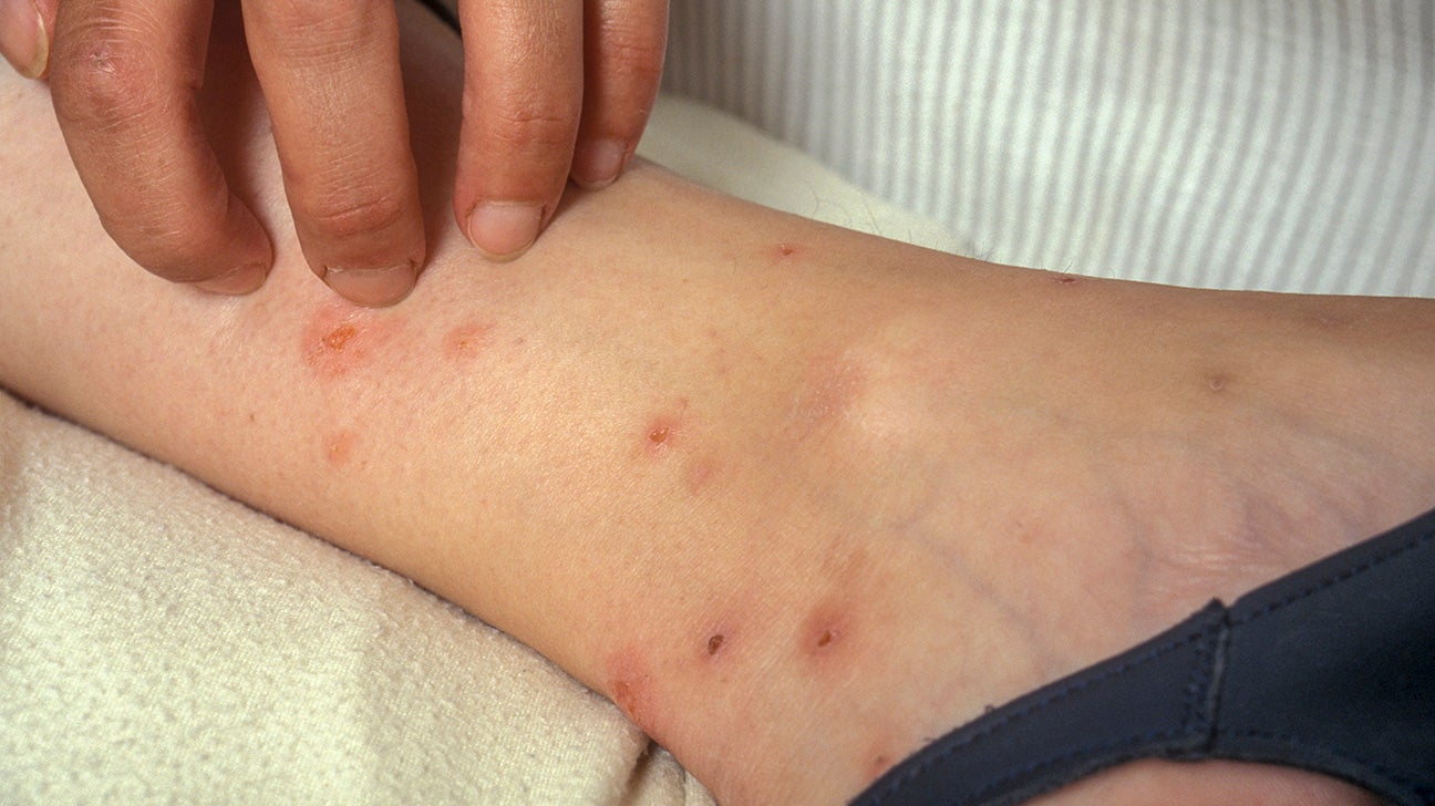 dust mites bites vs bed bugs bites