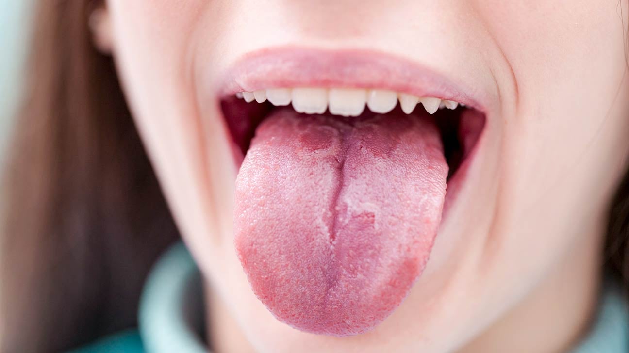 mild fissured tongue