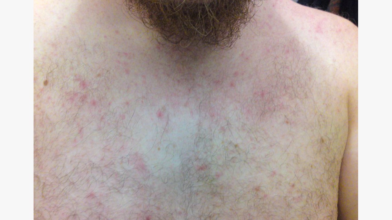 Woke up to find a rash on my breast.. what's causing this? : r