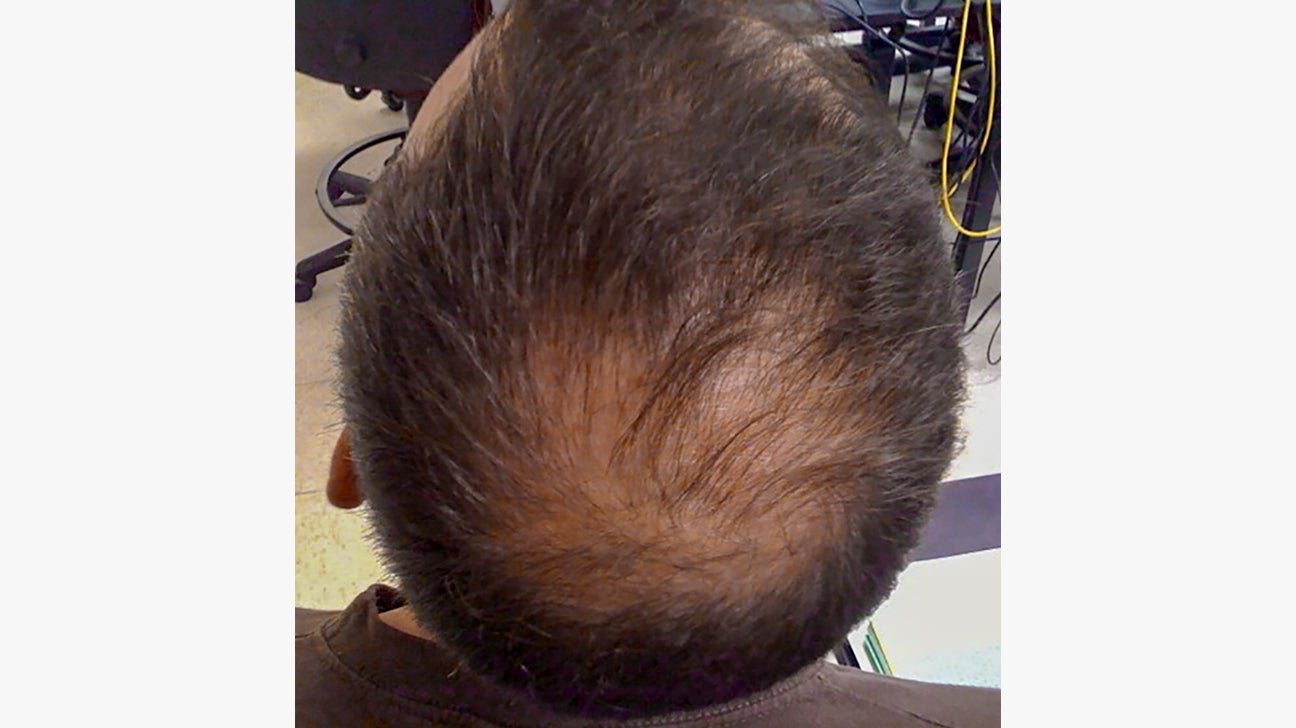 Hair Loss (Alopecia): Causes, Symptoms, and Regrowth Options