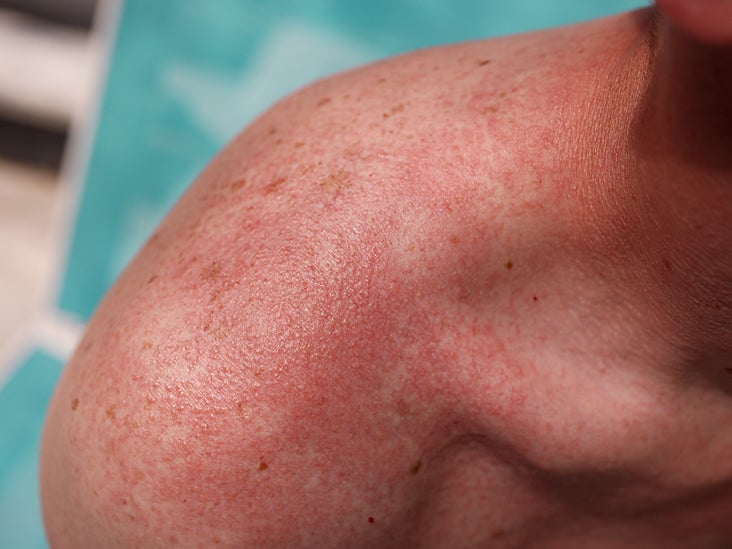Male Shoulder With Severe Sunburn And Prickly Heat Rash 732x549 Thumbnail 