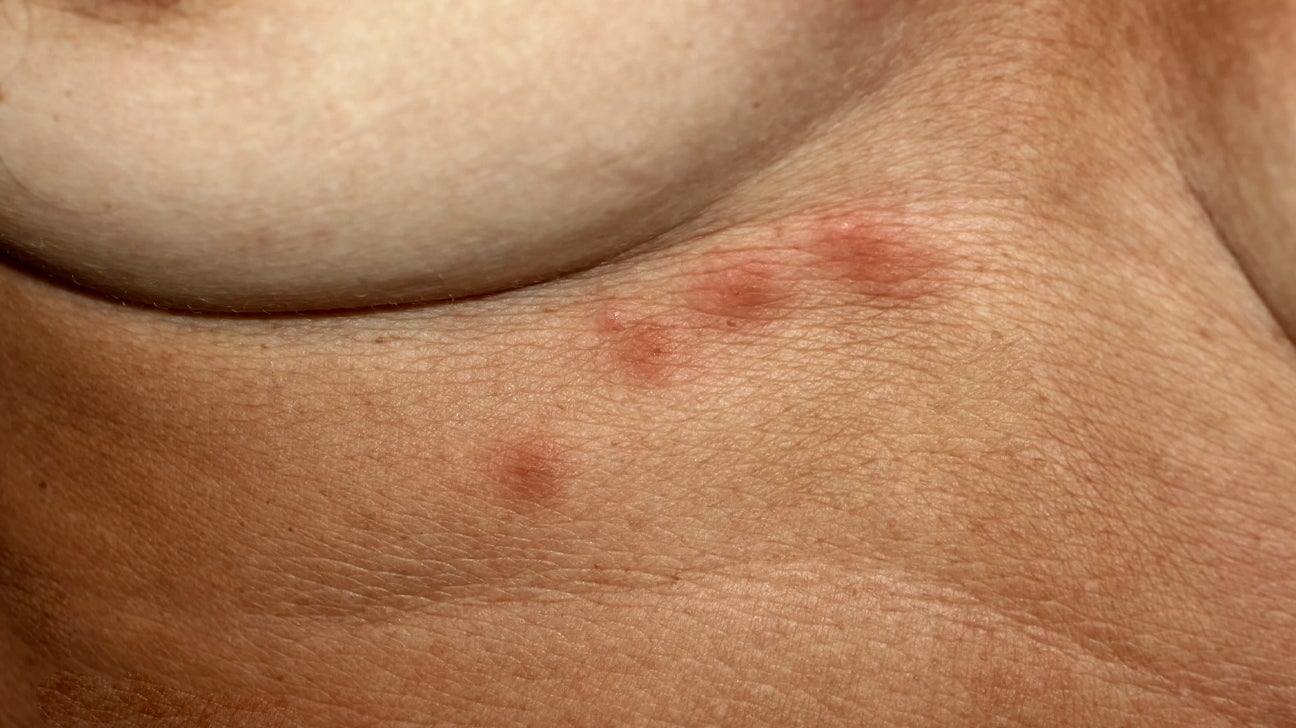Maiden ledsage Ungkarl What Causes a Rash on the Breast?