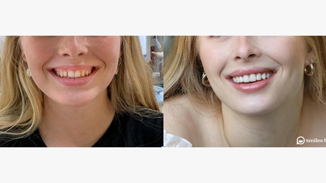No Prep Dental Veneers Before And After Body3 