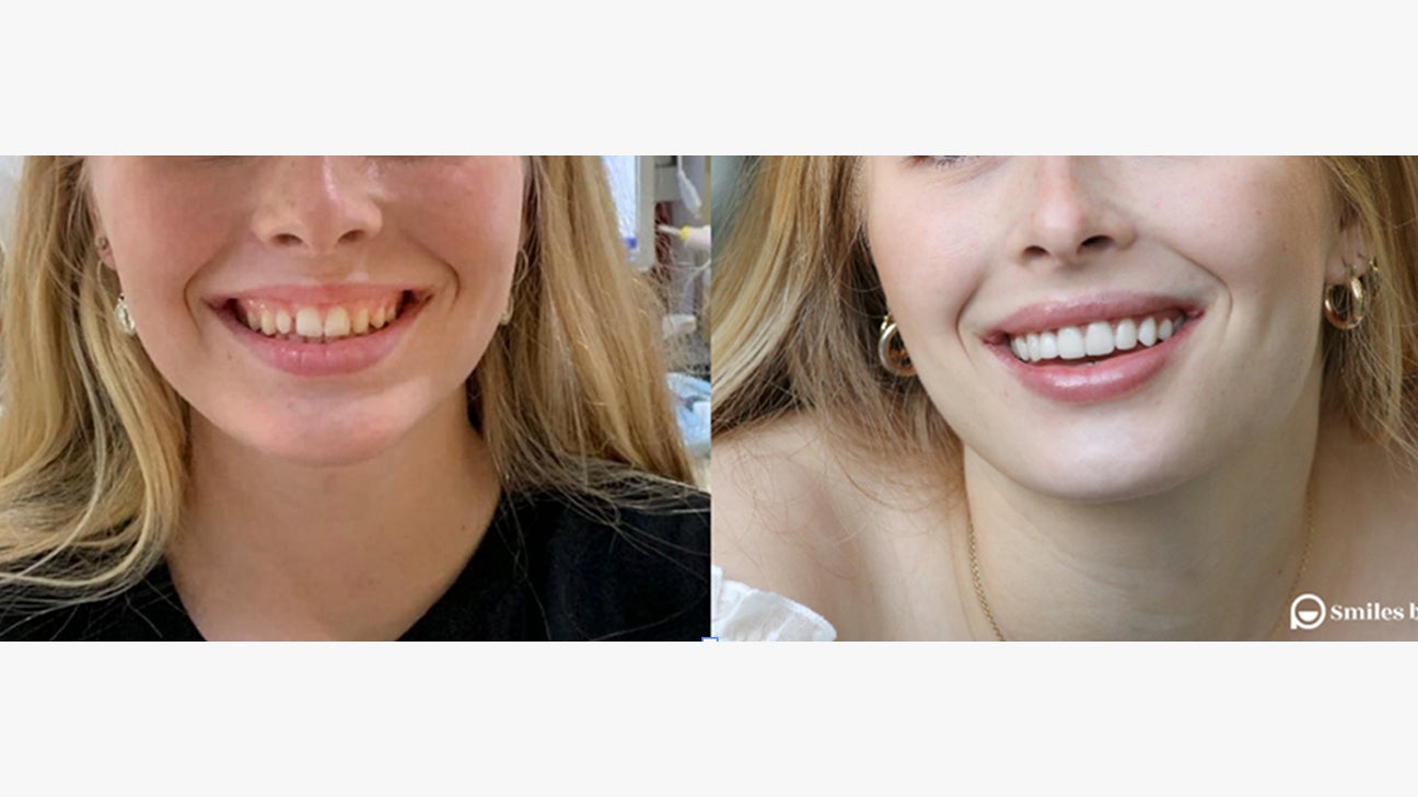 teeth before and after veneers