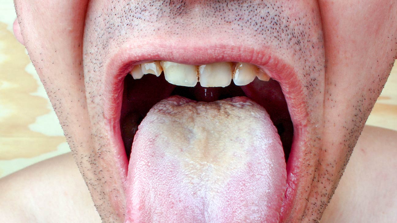 Type 2 Diabetes and Skin Pictures, Dermopathy, Infections, and More