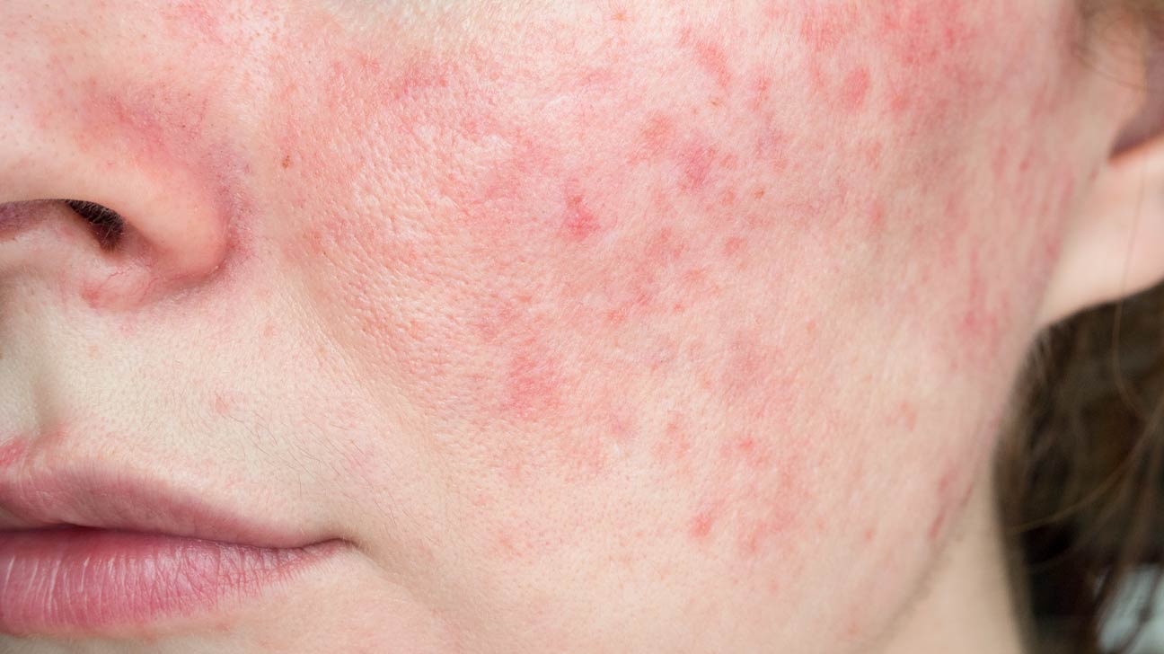 Empowering Solutions for Managing and Thriving with Rosacea