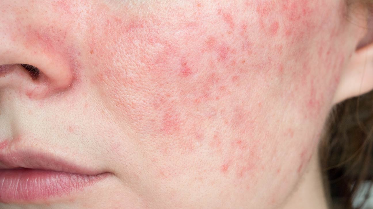 Papulopustular Rosacea: Symptoms, Triggers, and Treatment