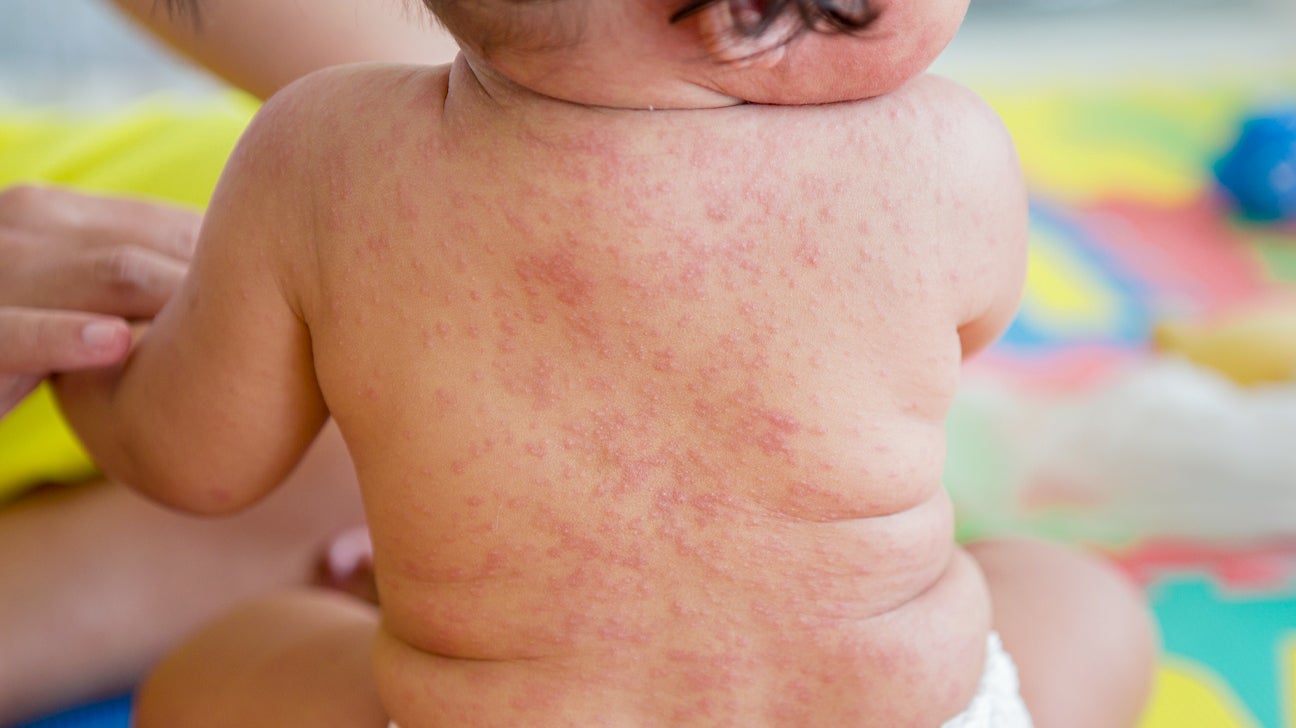 rashes in children with no fever