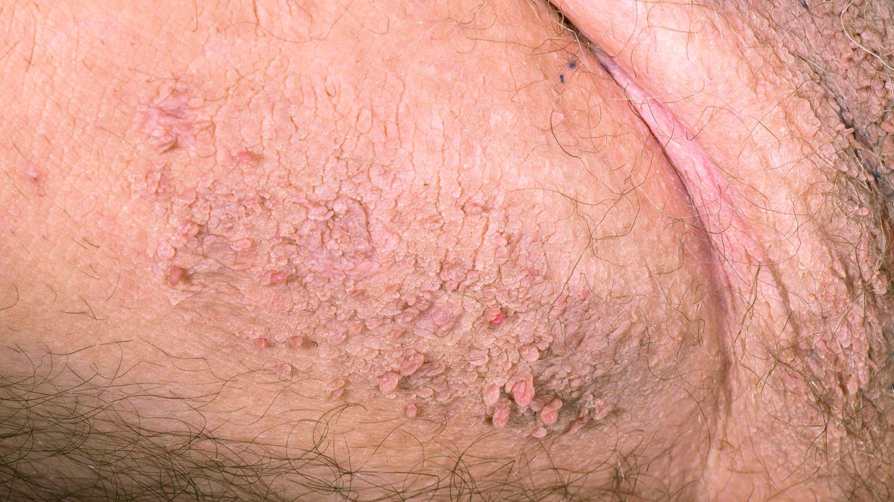 Wart skin lump - Bump papilom