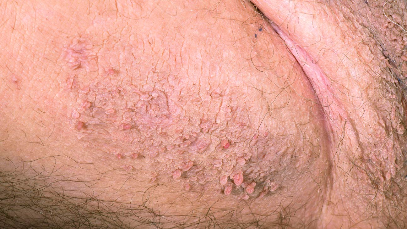 ingrown hair vs genital warts