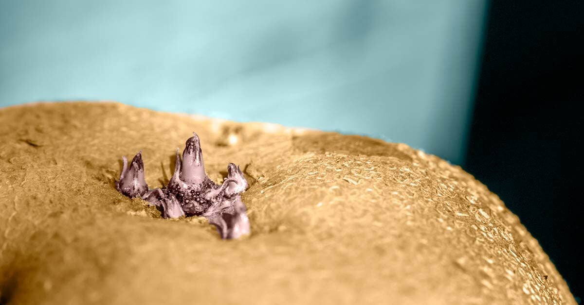 Anal skin tags are a common and benign skin issue. Here’s why they form, symptoms to watch for, options for removal, and more.