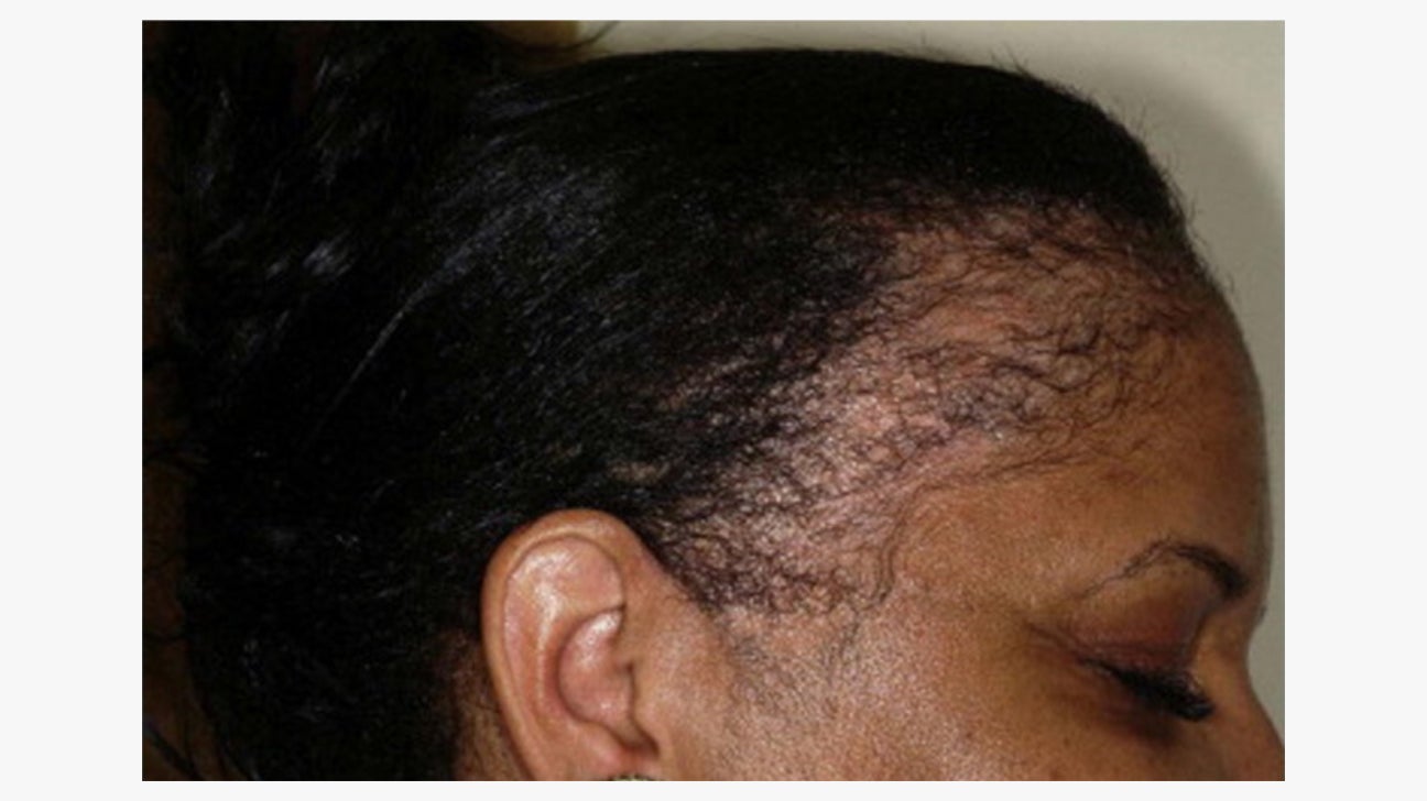 Hair Loss (Alopecia): Causes, Symptoms, and Regrowth Options