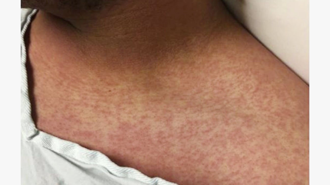 Viral Rash: Types, Symptoms, and Treatment in Adults and Babies