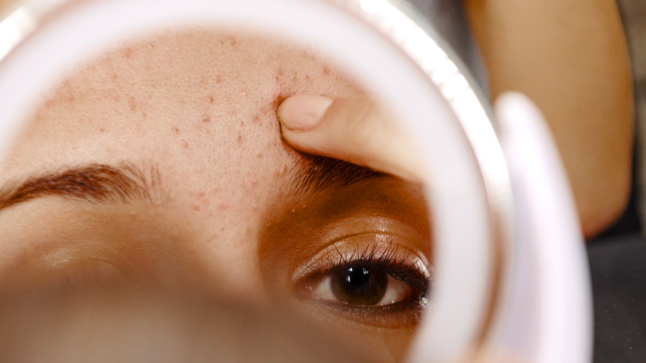 Guide to Professional Brown Spot Removal Treatment Options