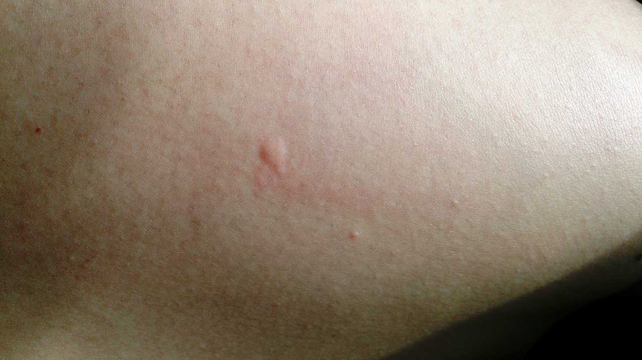 mild bed bug bites on legs