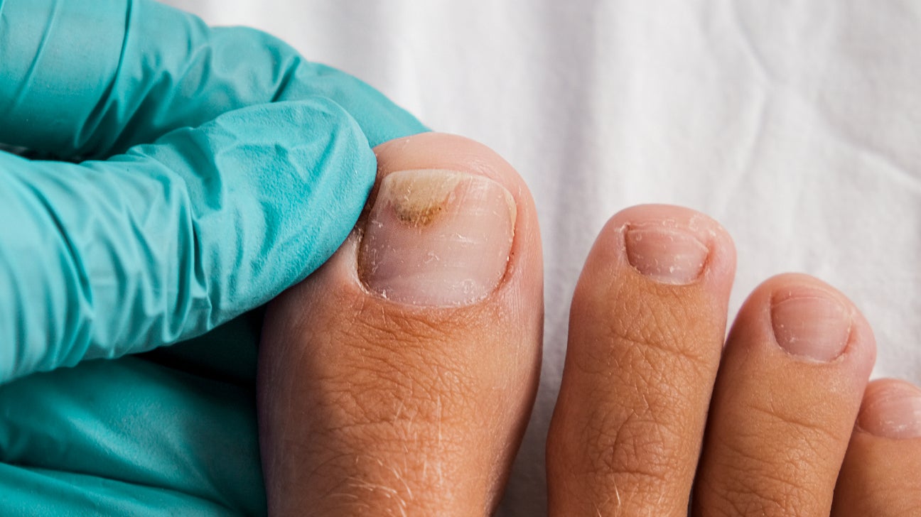 Injured Toe Nail - Footman Podiatry and Gait Analysis Clinic