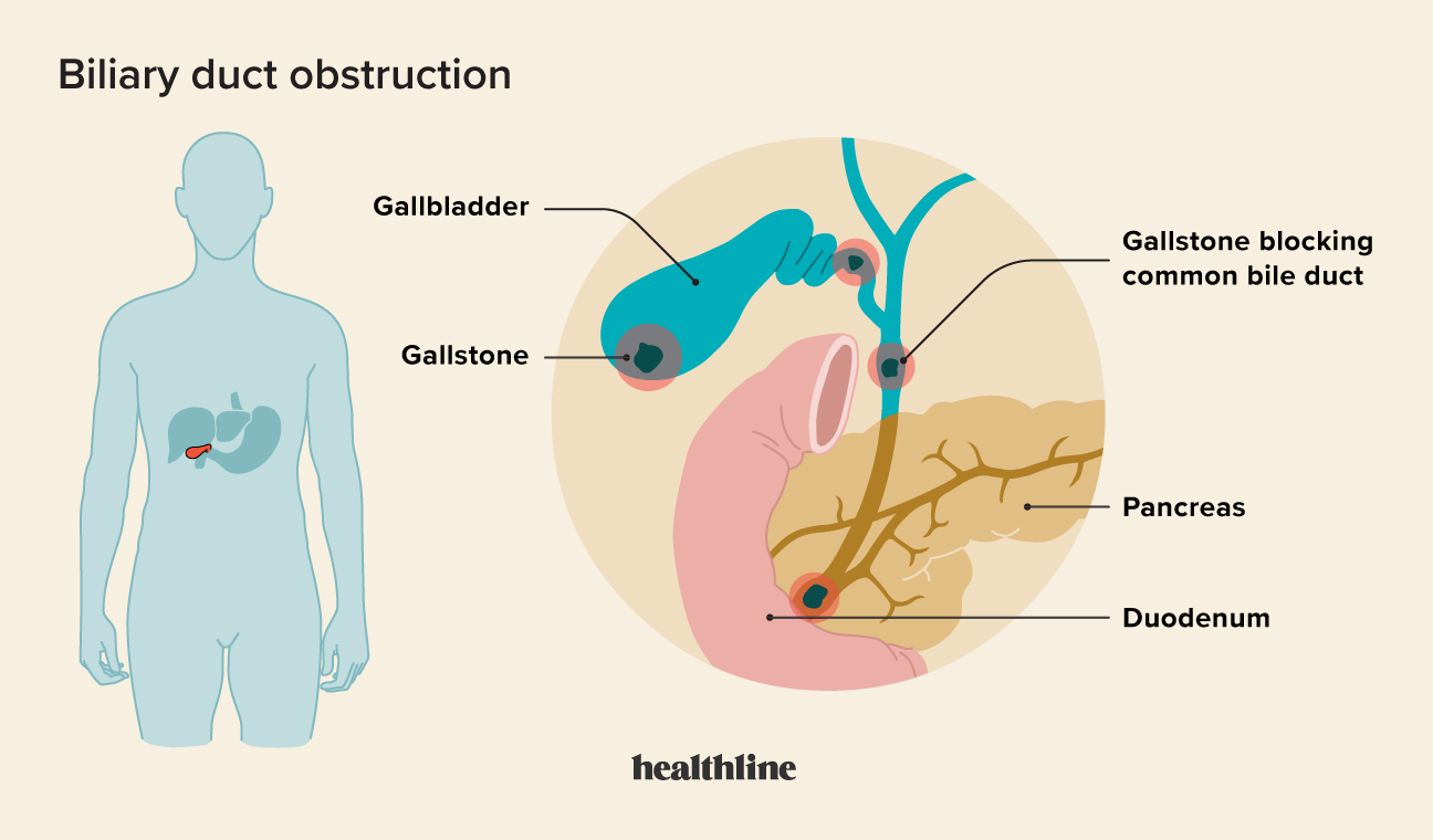  Bile Duct Obstruction Symptoms Treatment And Causes