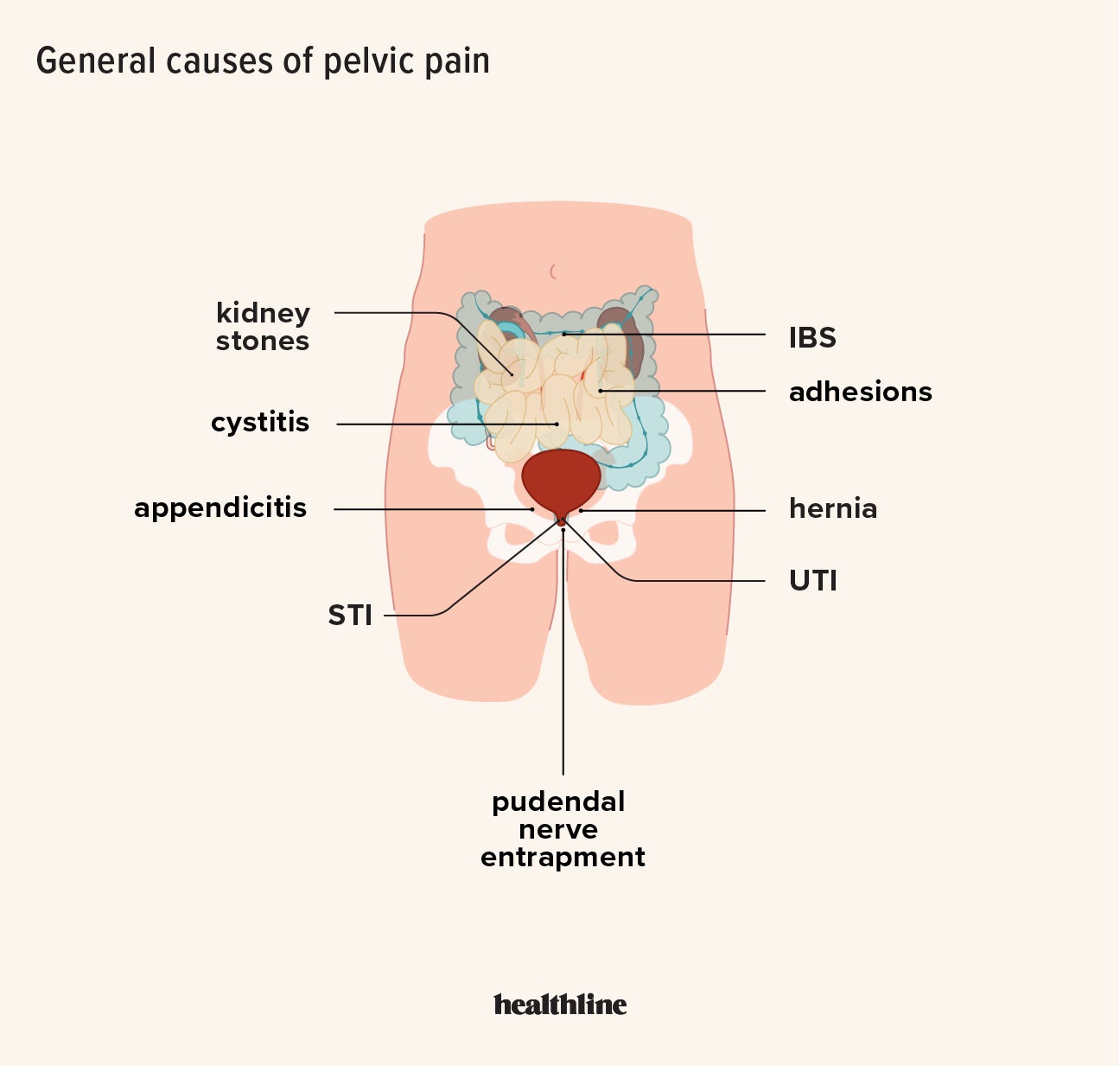 Pain in Pelvis: 24 Causes in Men and Women, Plus Other Symptoms