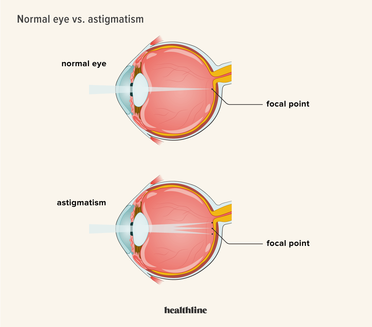 Person With Astigmatism