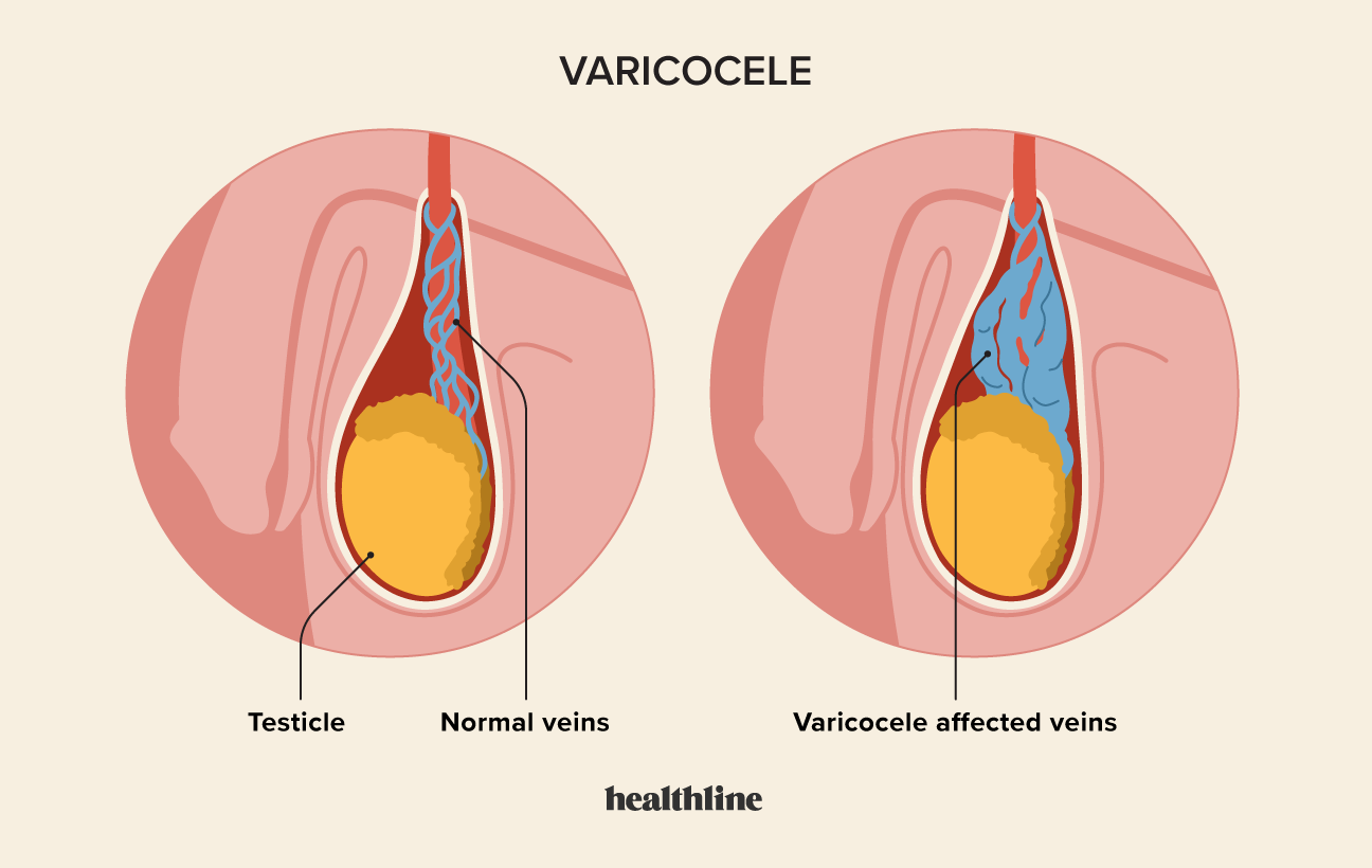Varicocele Treatment - What is the Best Cure for Varicocele?