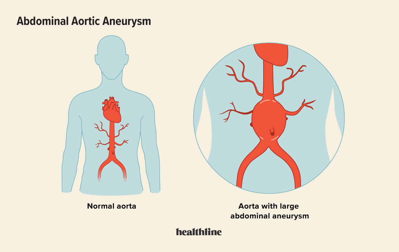 stomach aneurysm symptoms