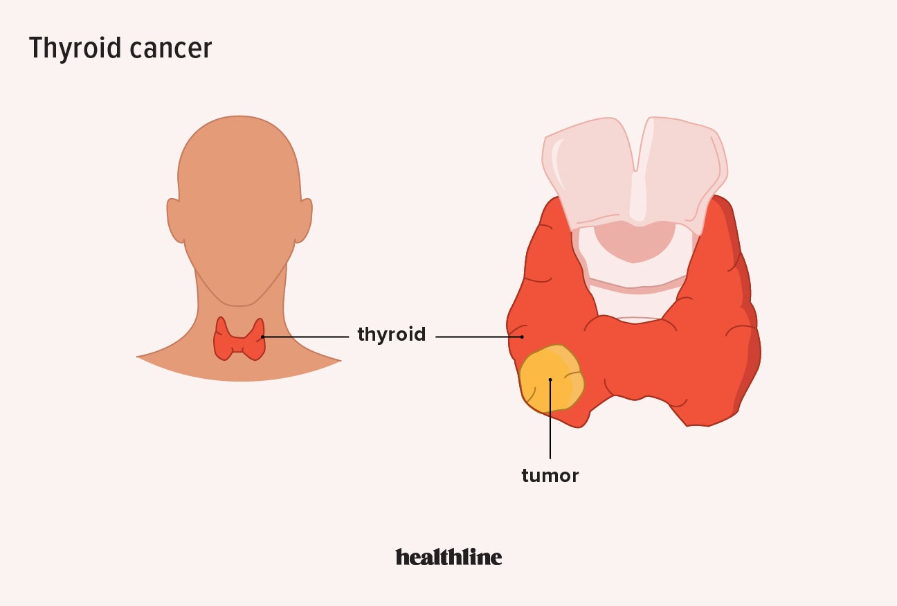 Thyroid Cancer Types Risk Factors And Symptoms