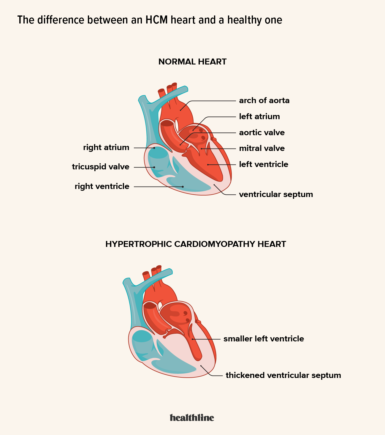 What Is Left Ventricular Hypertrophy PDF Ventricle Heart 43 OFF