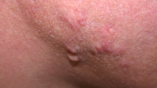 inside pimples