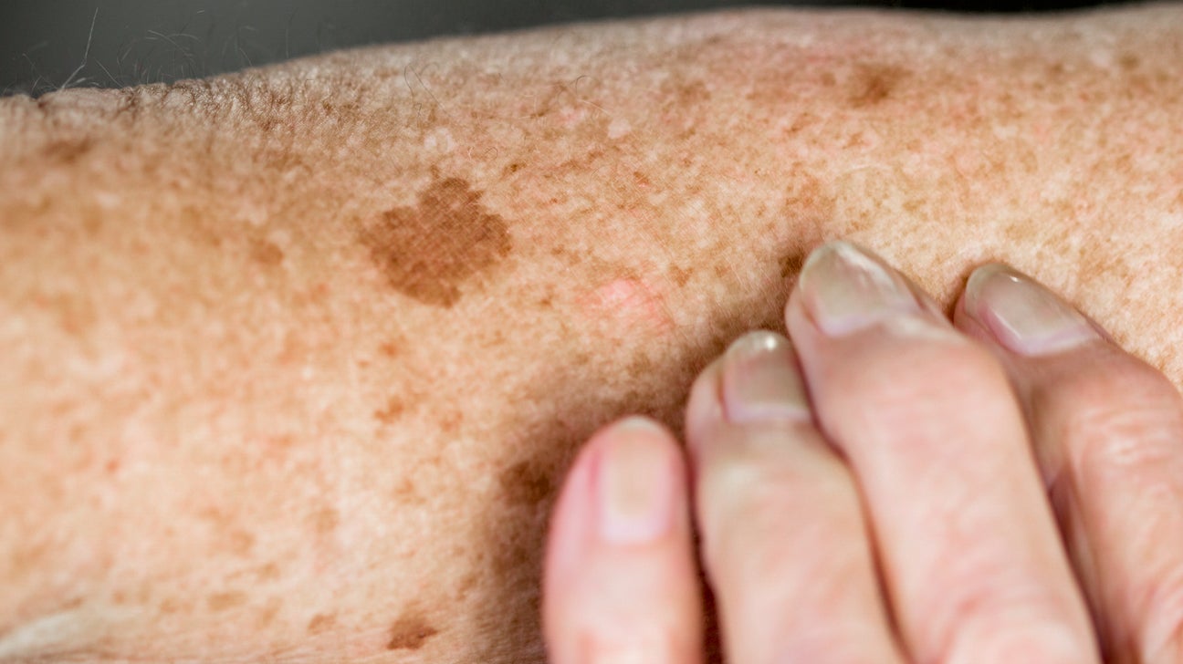 Age spots (liver spots) - Symptoms & causes - Mayo Clinic