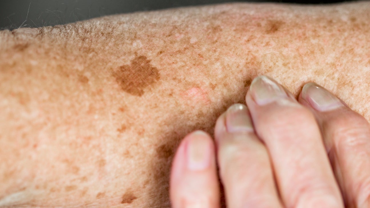 Age Spots Causes Symptoms And Diagnosis