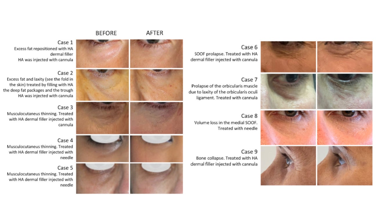 Tear Trough Filler Procedure, Safety, Cost and Results pic photo