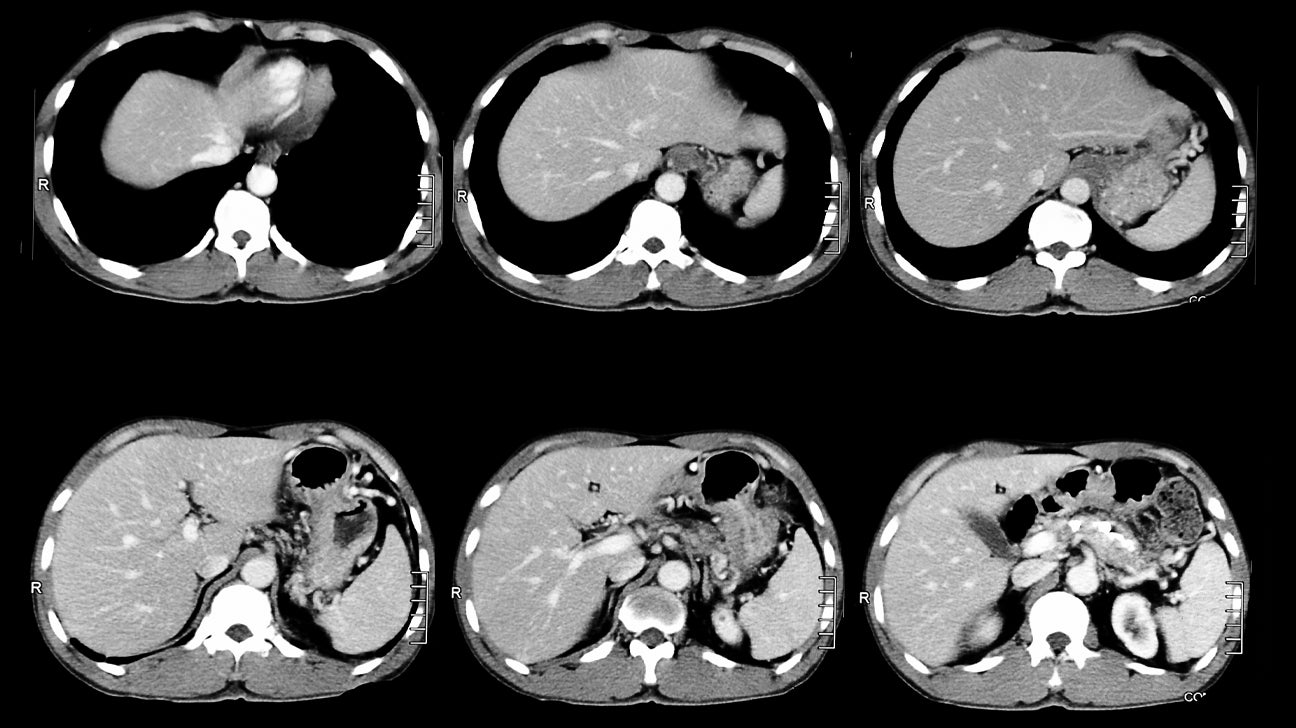 CT Scan (CAT Scan): Procedure, Risks, and Results