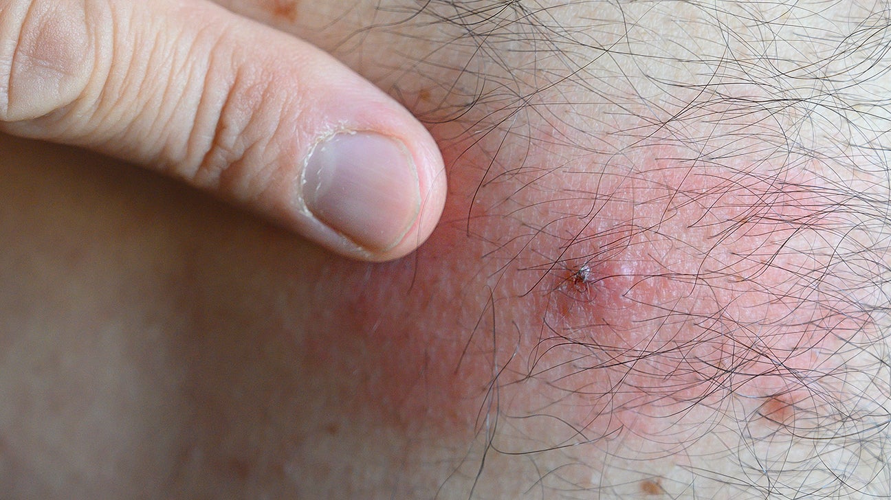 Mosquito Bites on the Skin Under the Breast Stock Photo - Image of