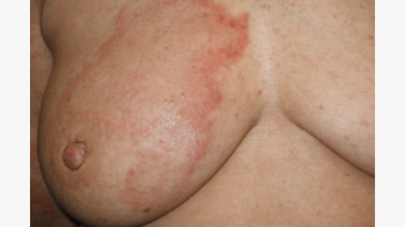 Red marks on breasts, non-itchy & non-painful. They hang around for about a  month, slowly fading to orange then go. Have had this problem for a few  years now with only one