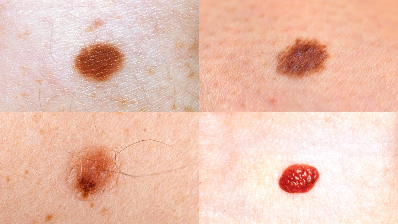 Mole Vs Skin Tag Understanding The Difference