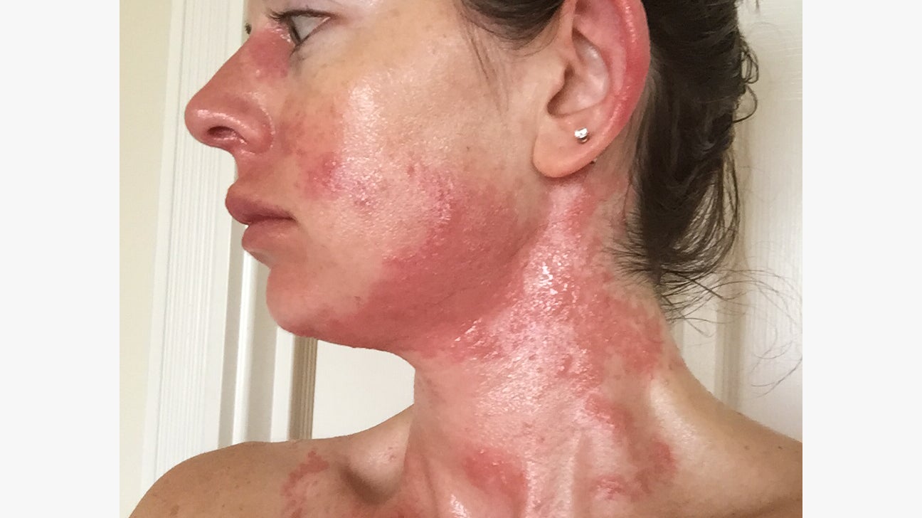 shingles rash on face
