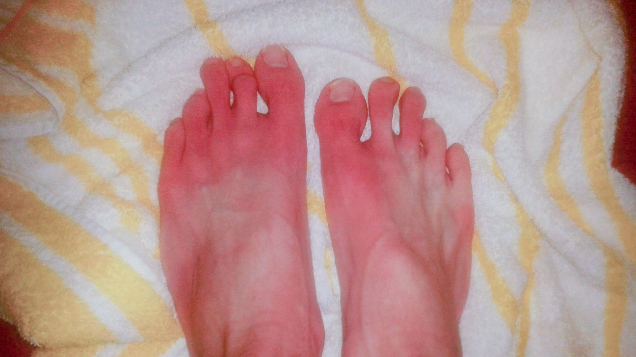 Limited Disco Lager Erythromelalgia: Symptoms, Causes, Treatment & More