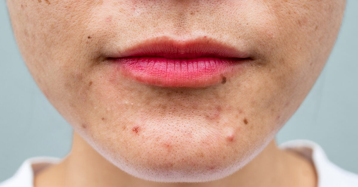 Acne: what to do Changes: 5 Actionable Tips