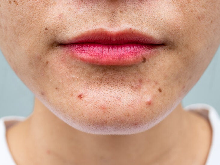 Adapalene Making Acne Worse Lillian Hart