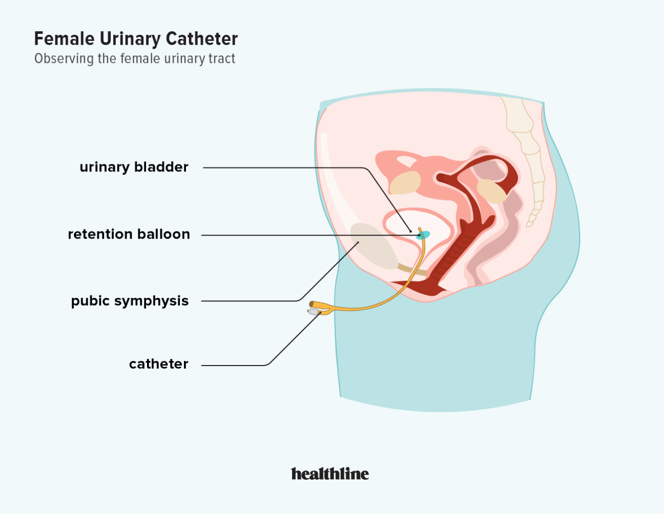 urinary-catheters-uses-types-and-complications