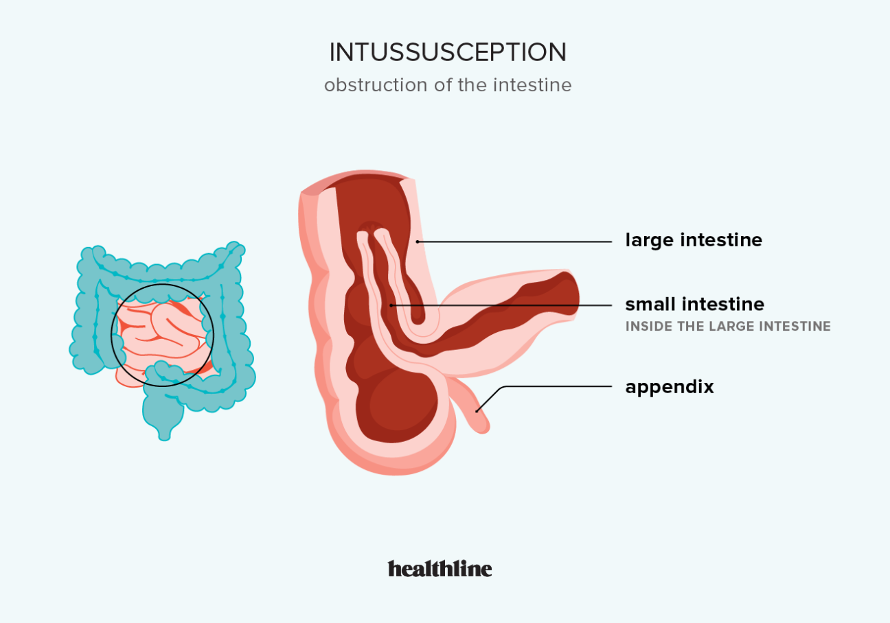 Intussusception: Symptoms, Causes, Diagnosis & Treatment
